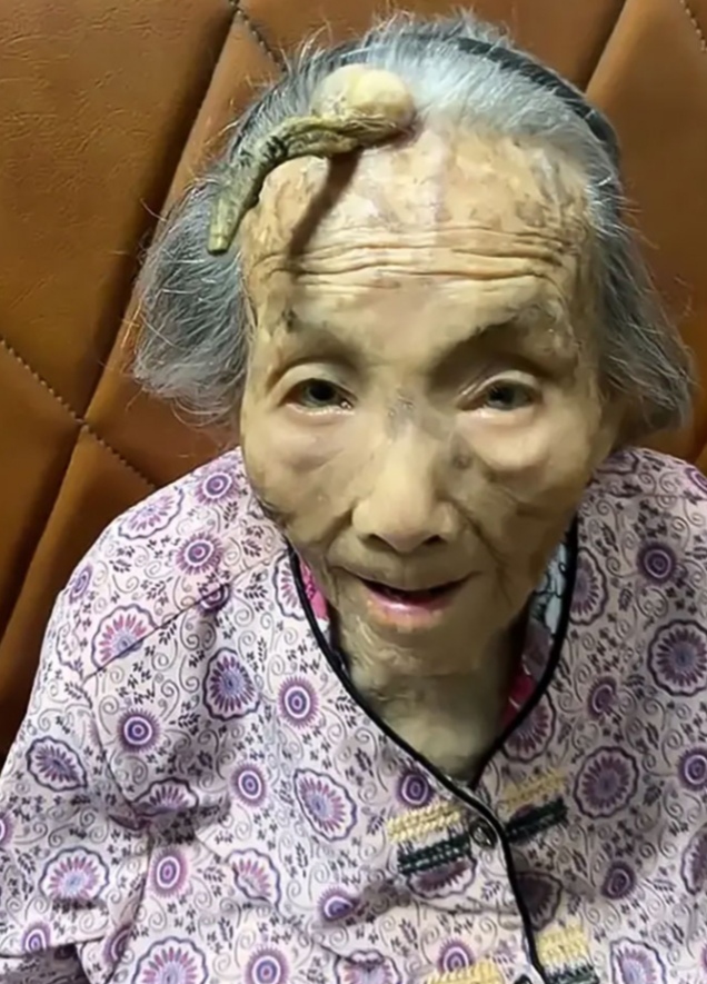 “This is too risky”: 107YO went viral because the 4-inch “Longevity Horn” growing on her forehead was said to be due to… see more